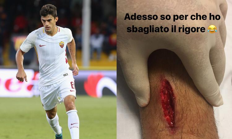 Roma, 10 punti di sutura per Perotti: 'Ecco perchè ho fallito il rigore' FOTO