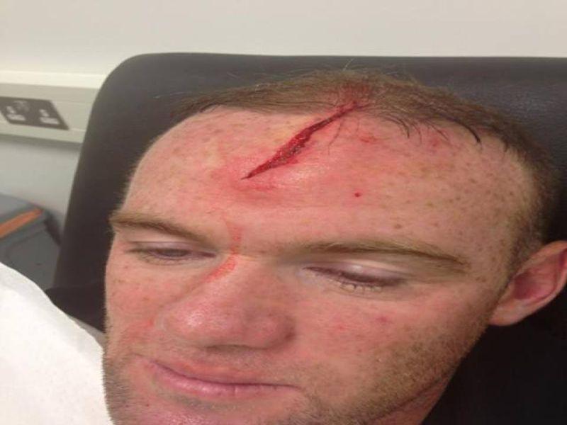 Rooney, guardate che squarcio in testa!