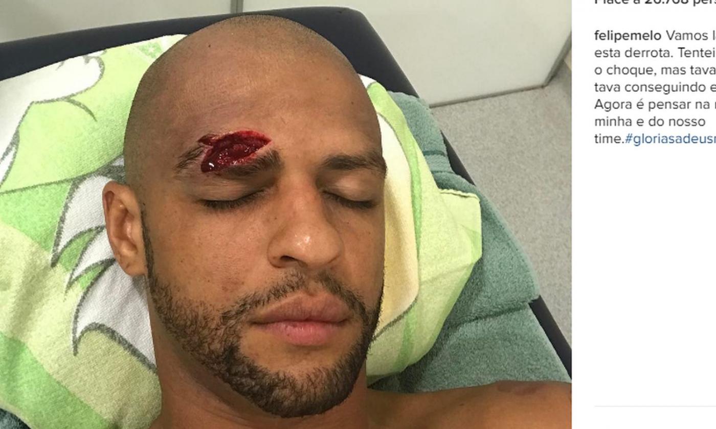 Felipe Melo, taglio horror: 13 punti di sutura! FOTO